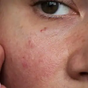 Ultracalming - sensitivitet/rødhet